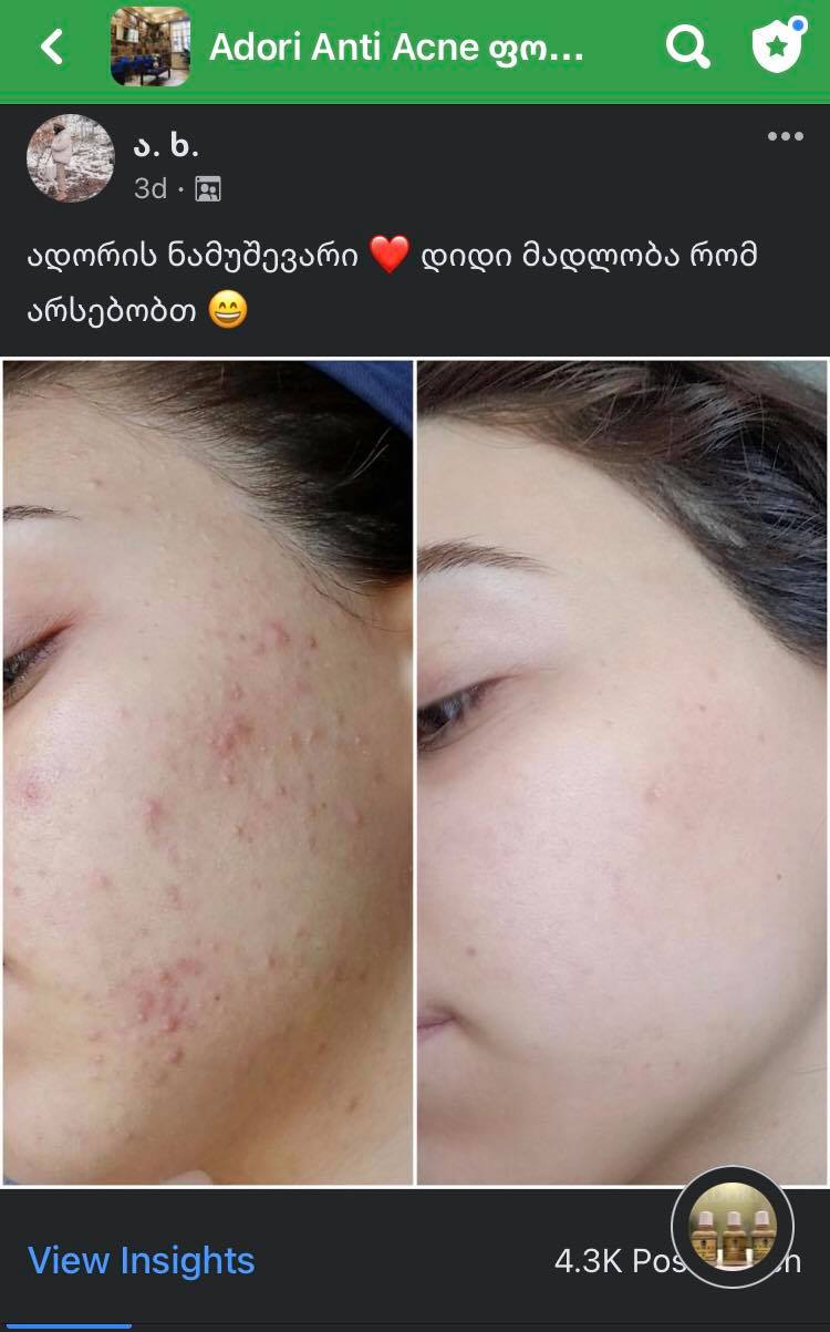 პაციენტის 12 თვიანი მკურნალობის შედეგი