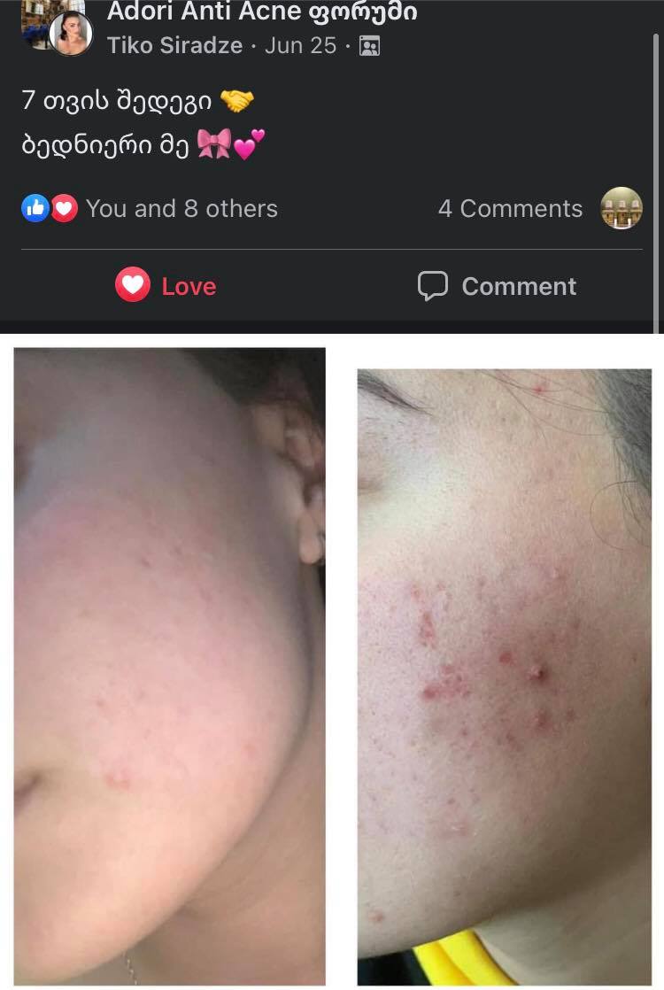 პაციენტის 7 თვის მკურნალობის შედეგი