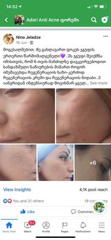 ნაწიბურებზე მკურნალობის 6 თვის შედეგი