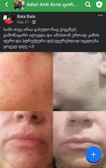 პაციენტის 3 თვის მკურნალობის შედეგი