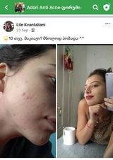 10 თვის მკურნალობის შედეგი