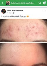 პაციენტის 5 თვის მკურნალობის შედეგი