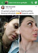 პაციენტის 9 თვის მკურნალობის შედეგი