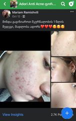 მკურნალობის 1 წლის შედეგი