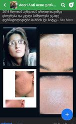 1 წლის მკურნალობი9ს შედეგი