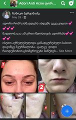 1 წლის მკურნალობის შედეგი