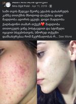 3 თვის მკურნალობის შედეგი