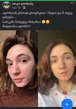 21 თვის მკურნალობის შედეგი