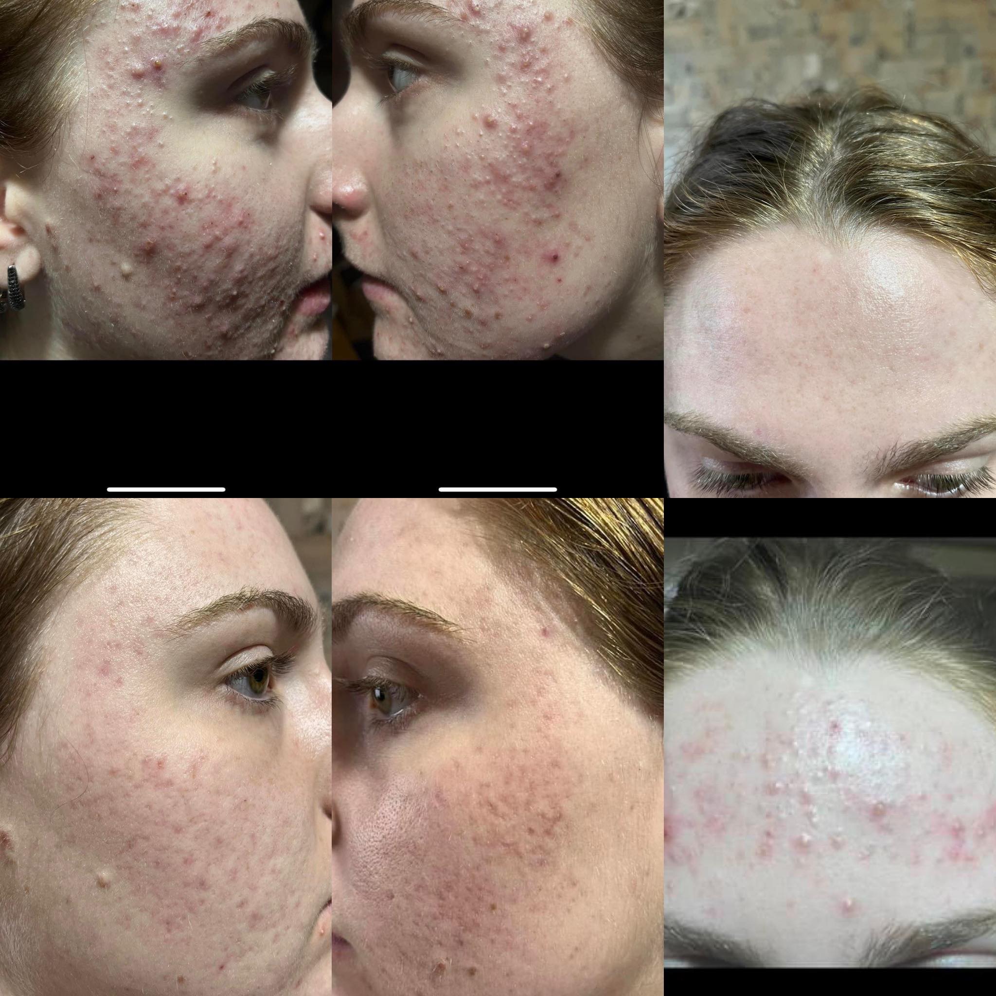 აკნეს მკურნალობა ადორში